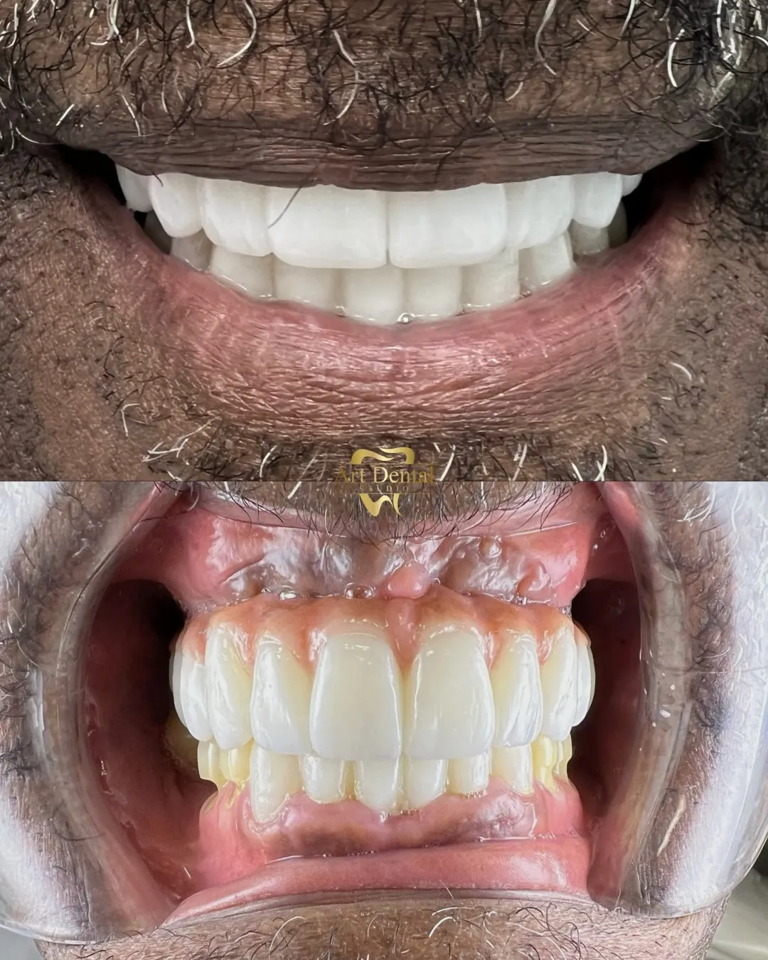 Patient 68: before / after