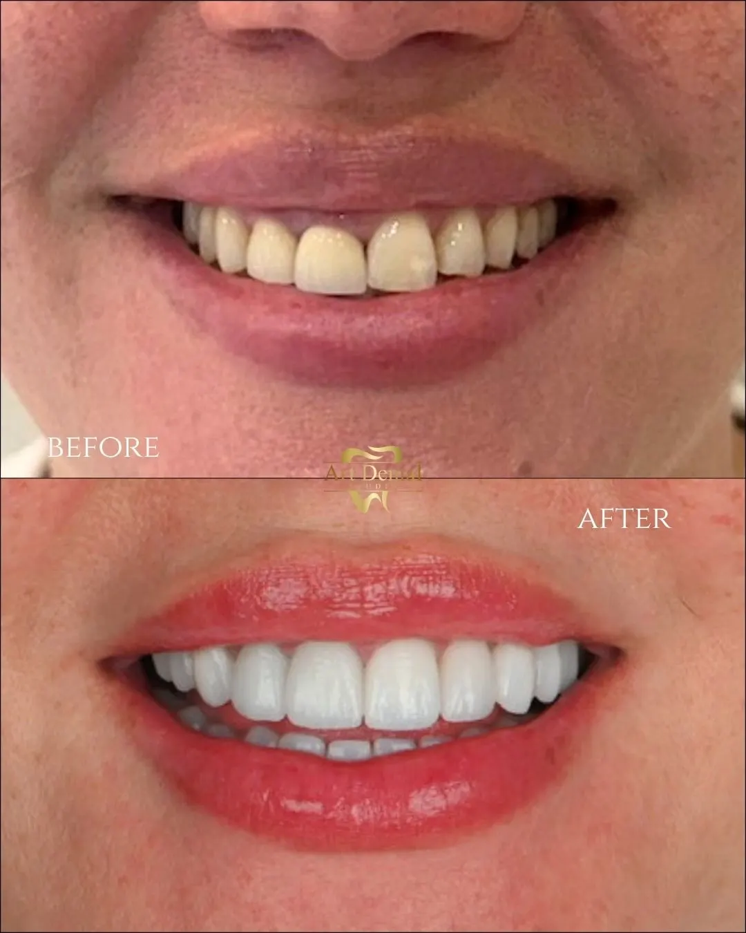 Patient 74: before / after