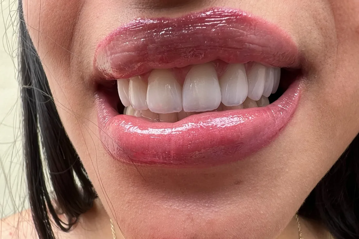 Primer plano de la sonrisa de un paciente, fotografiada en Art Dental Studio