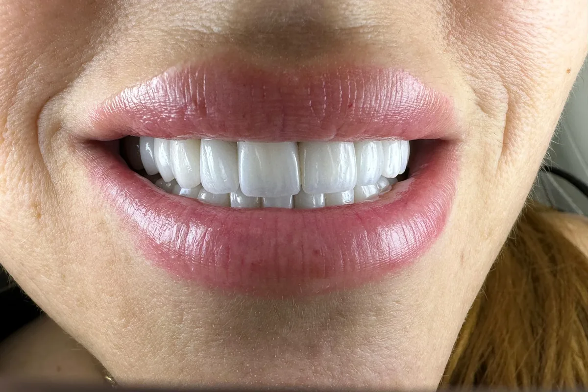 Primer plano de la sonrisa de un paciente, fotografiada en Art Dental Studio