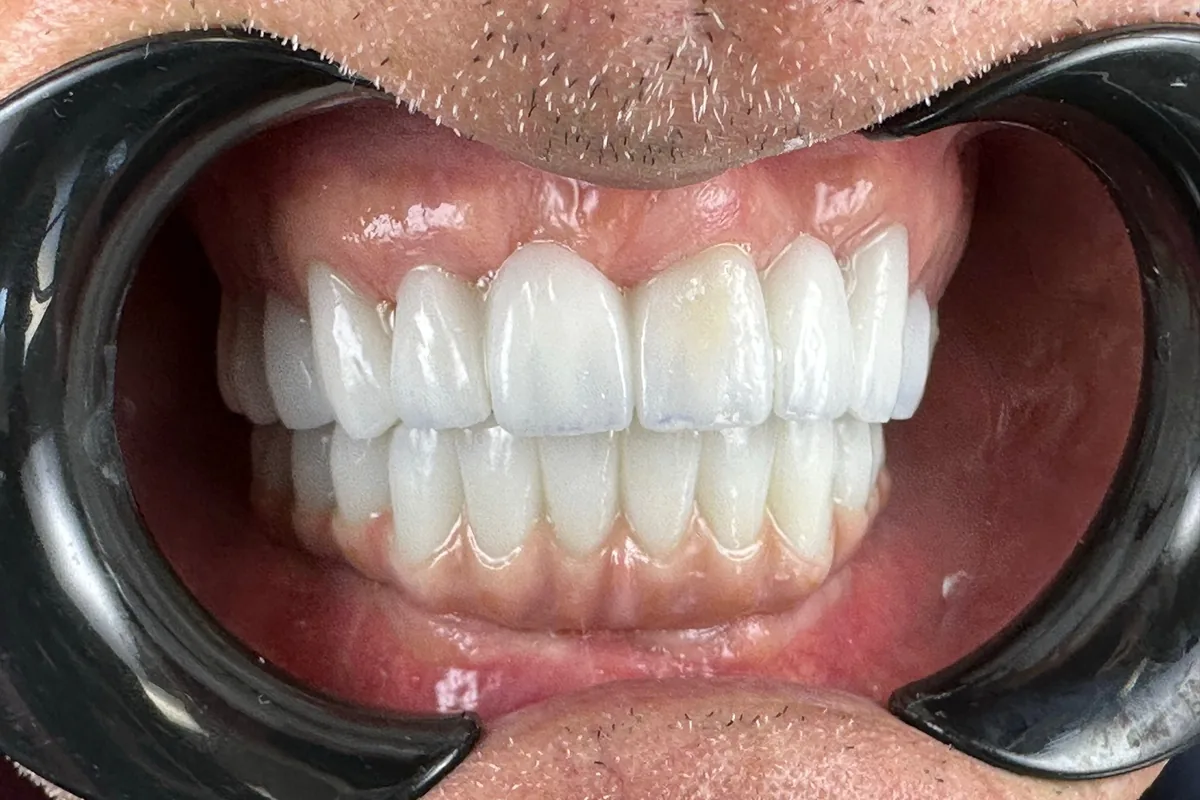 Close-up of a patient's smile, photographed at Art Dental Studio
