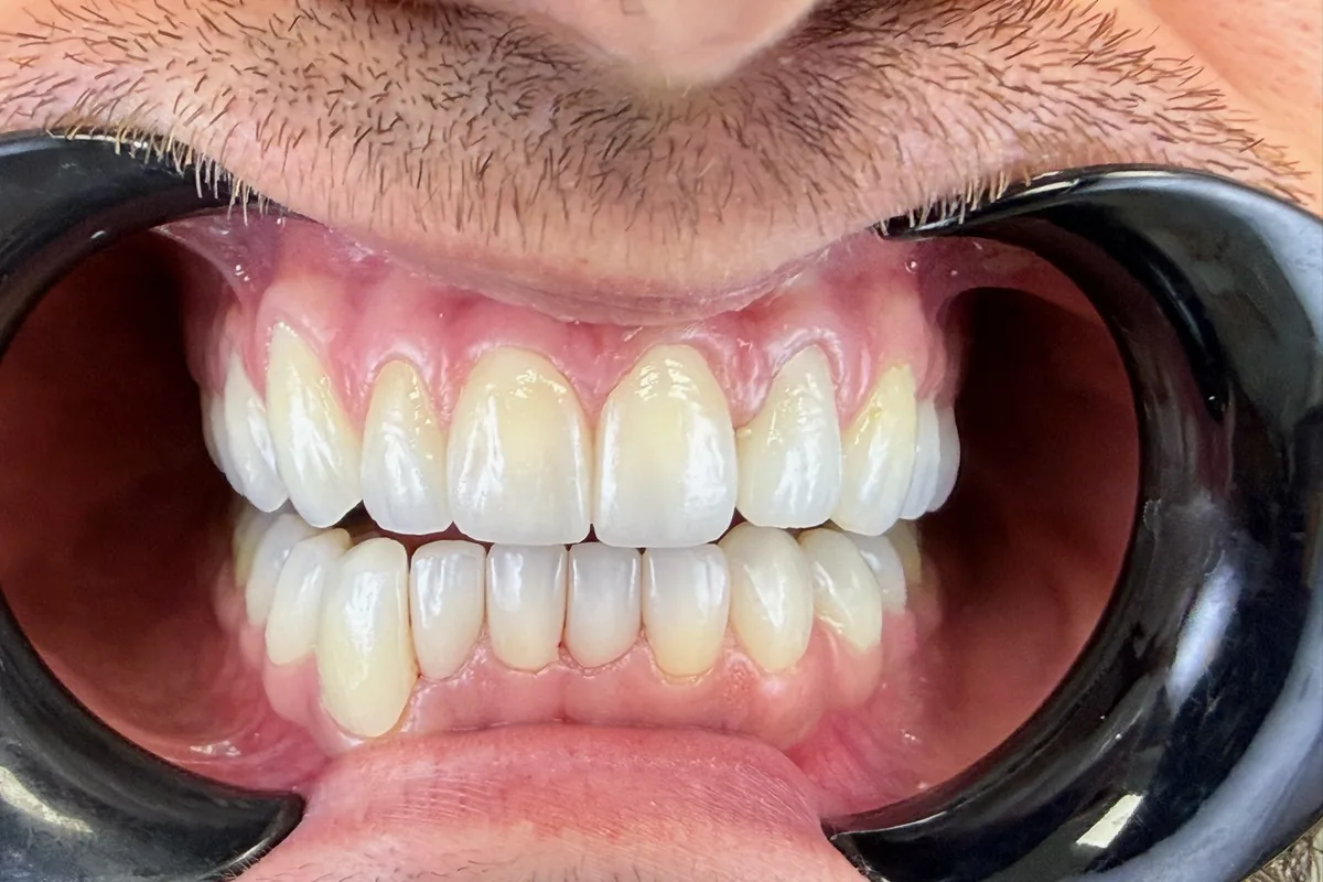 Close-up of a patient's smile, photographed at Art Dental Studio