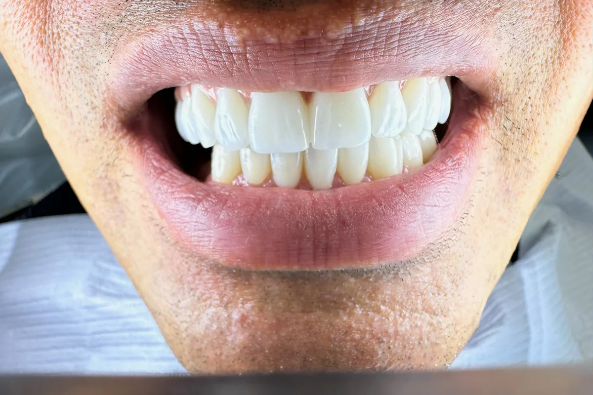 Close-up of a patient's smile, photographed at Art Dental Studio