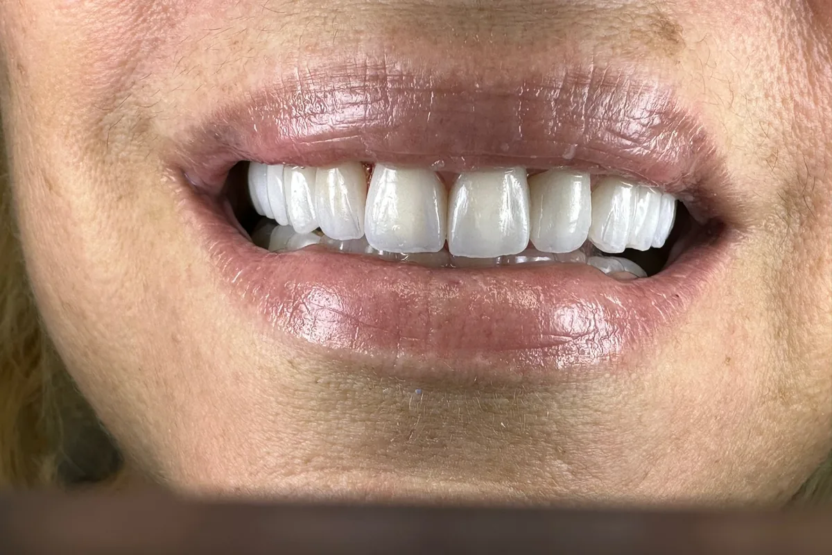 Close-up of a patient's smile, photographed at Art Dental Studio
