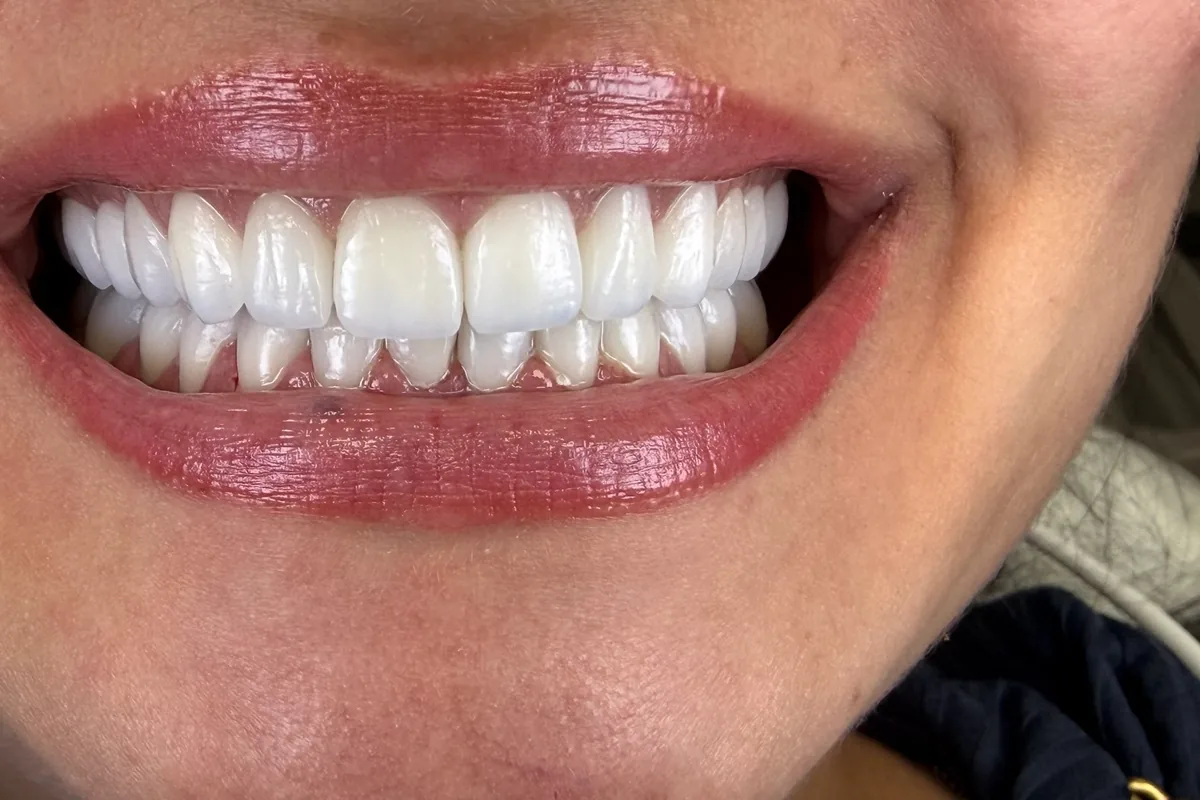 Primer plano de la sonrisa de un paciente, fotografiada en Art Dental Studio