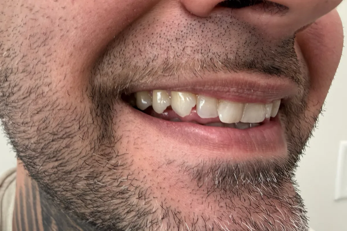 Close-up of a patient's smile, photographed at Art Dental Studio