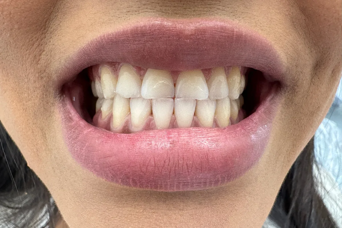Close-up of a patient's smile, photographed at Art Dental Studio