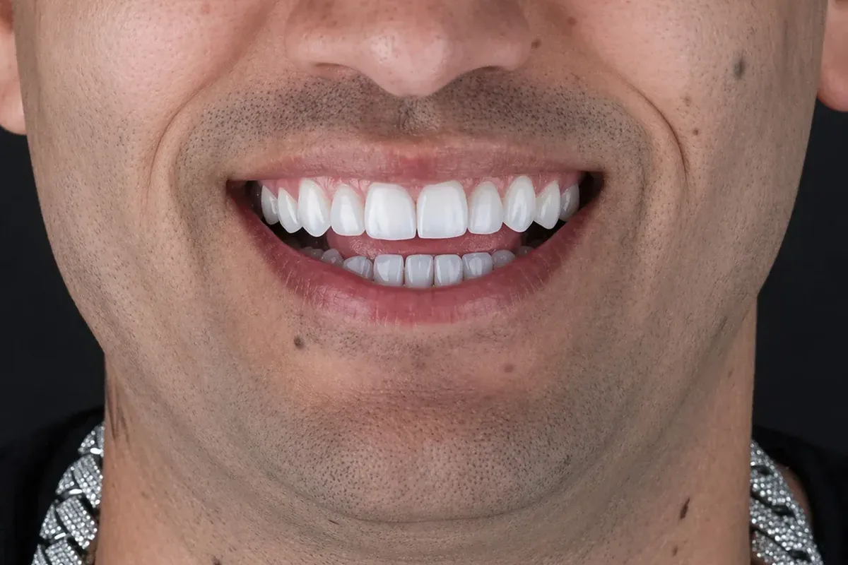 Close-up of a patient's smile, photographed at Art Dental Studio