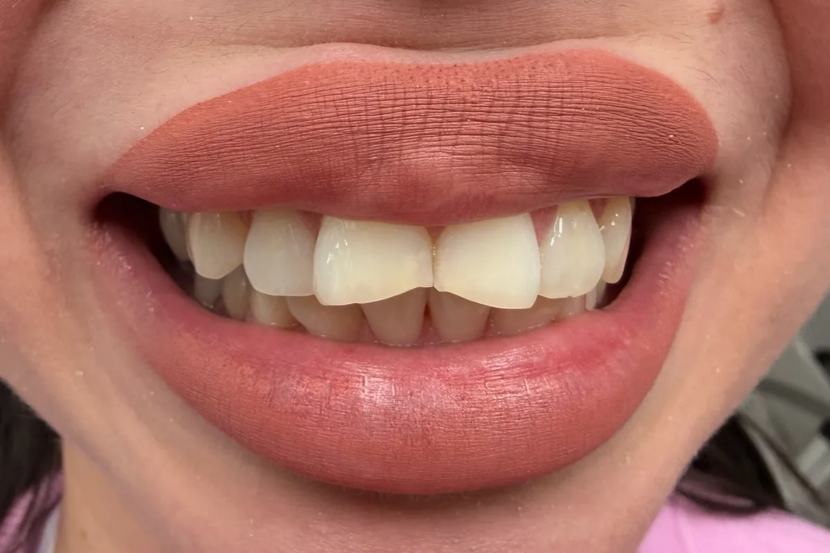 Close-up of a patient's smile, photographed at Art Dental Studio