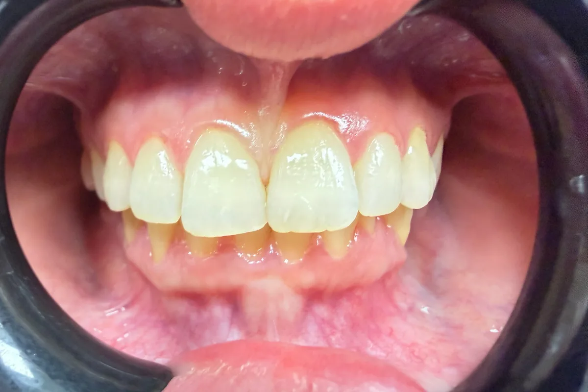 Primer plano de la sonrisa de un paciente, fotografiada en Art Dental Studio