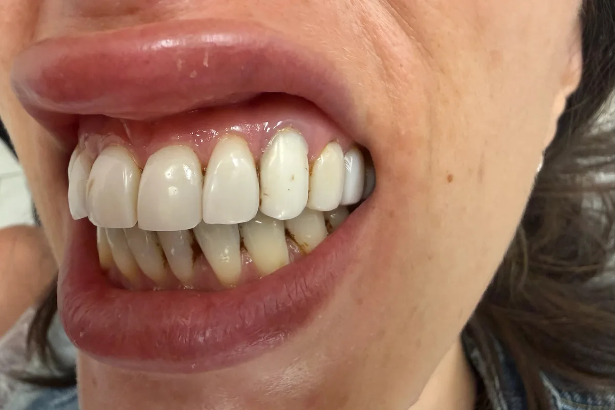 Primer plano de la sonrisa de un paciente, fotografiada en Art Dental Studio