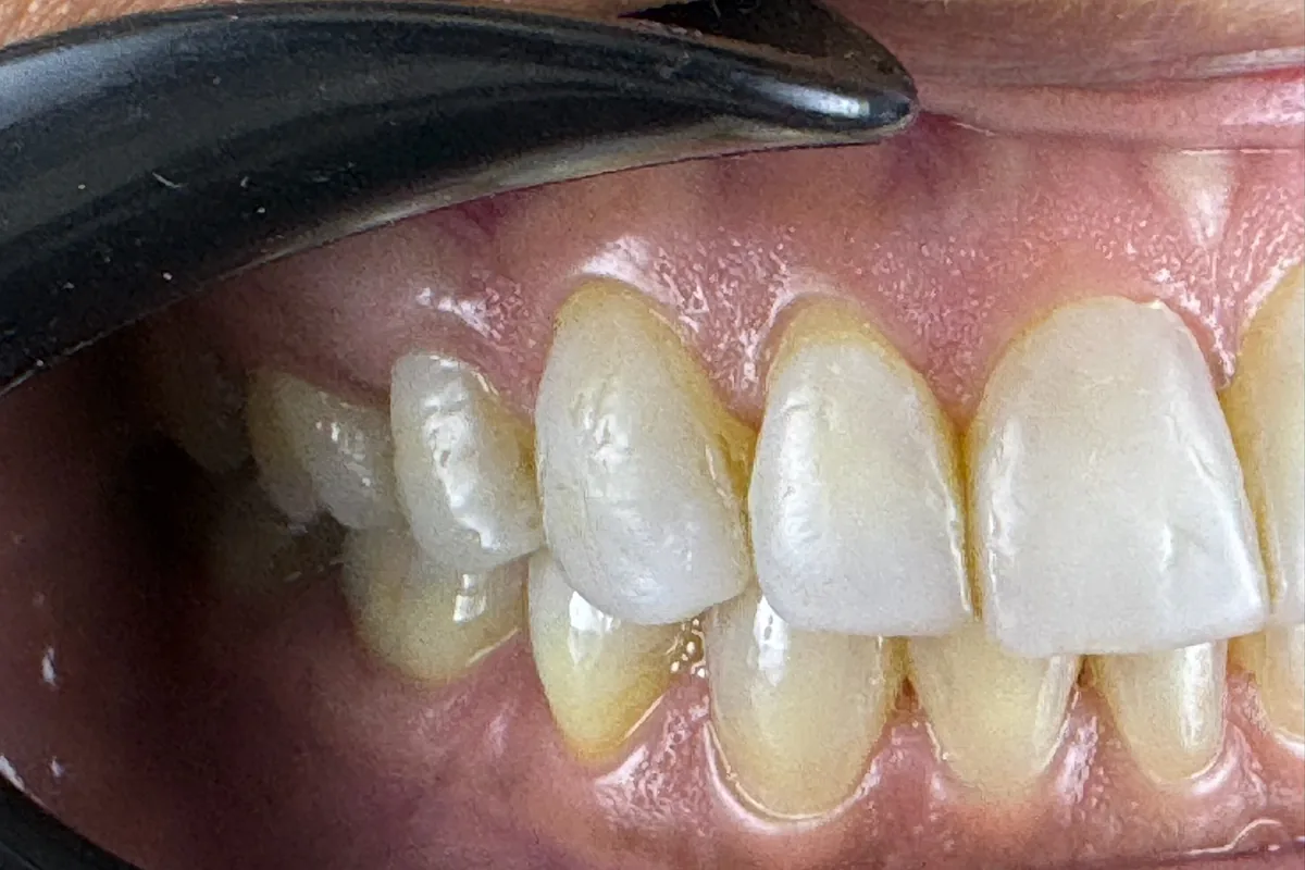 Primer plano de la sonrisa de un paciente, fotografiada en Art Dental Studio