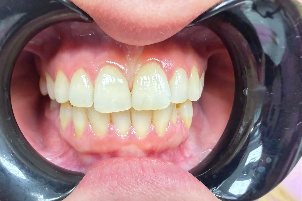 Primer plano de la sonrisa de un paciente, fotografiada en Art Dental Studio