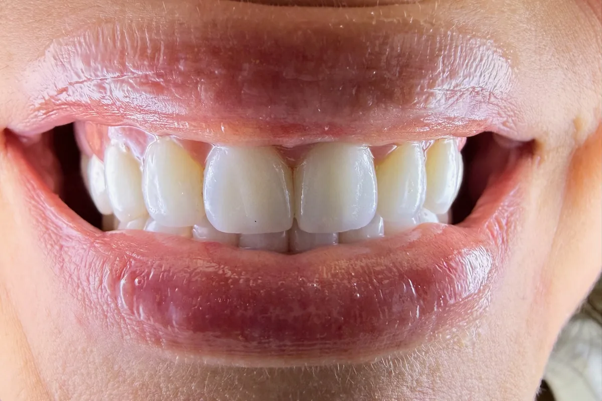 Primer plano de la sonrisa de un paciente, fotografiada en Art Dental Studio