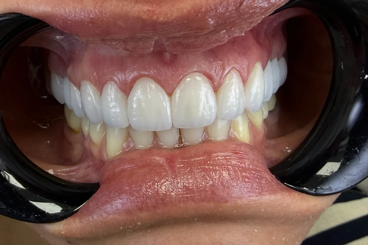 Primer plano de la sonrisa de un paciente, fotografiada en Art Dental Studio