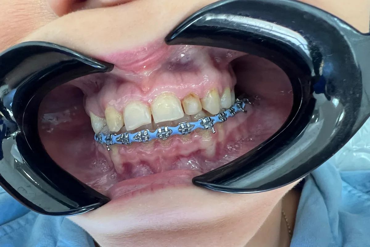 Orthodontic treatment photographed at Art Dental Studio
