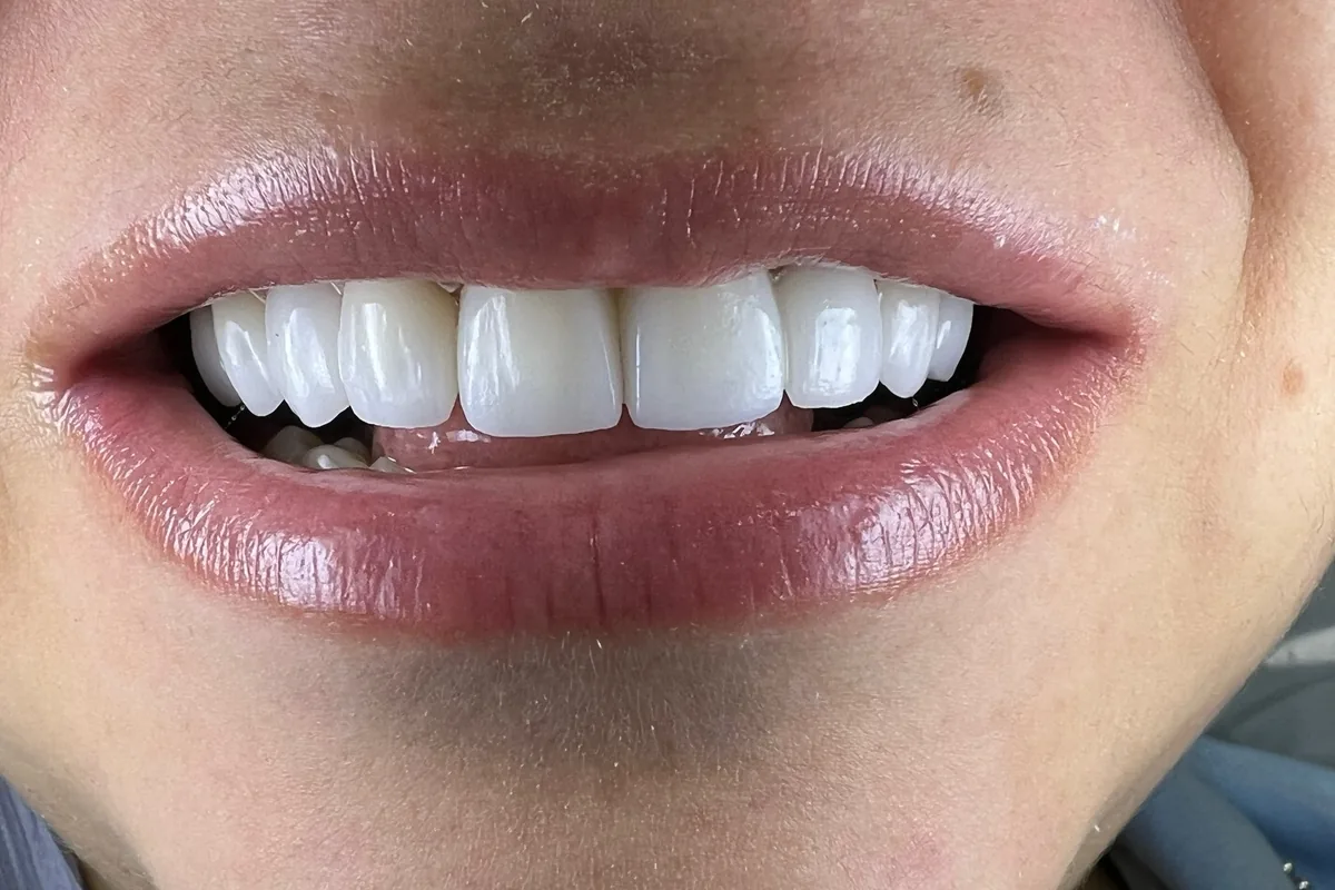 Close-up of a patient's smile, photographed at Art Dental Studio