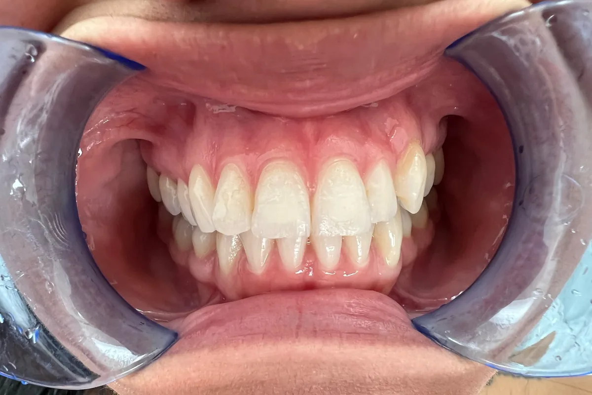 Close-up of a patient's smile, photographed at Art Dental Studio