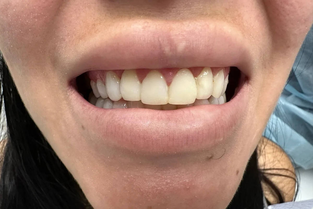 Close-up of a patient's smile, photographed at Art Dental Studio