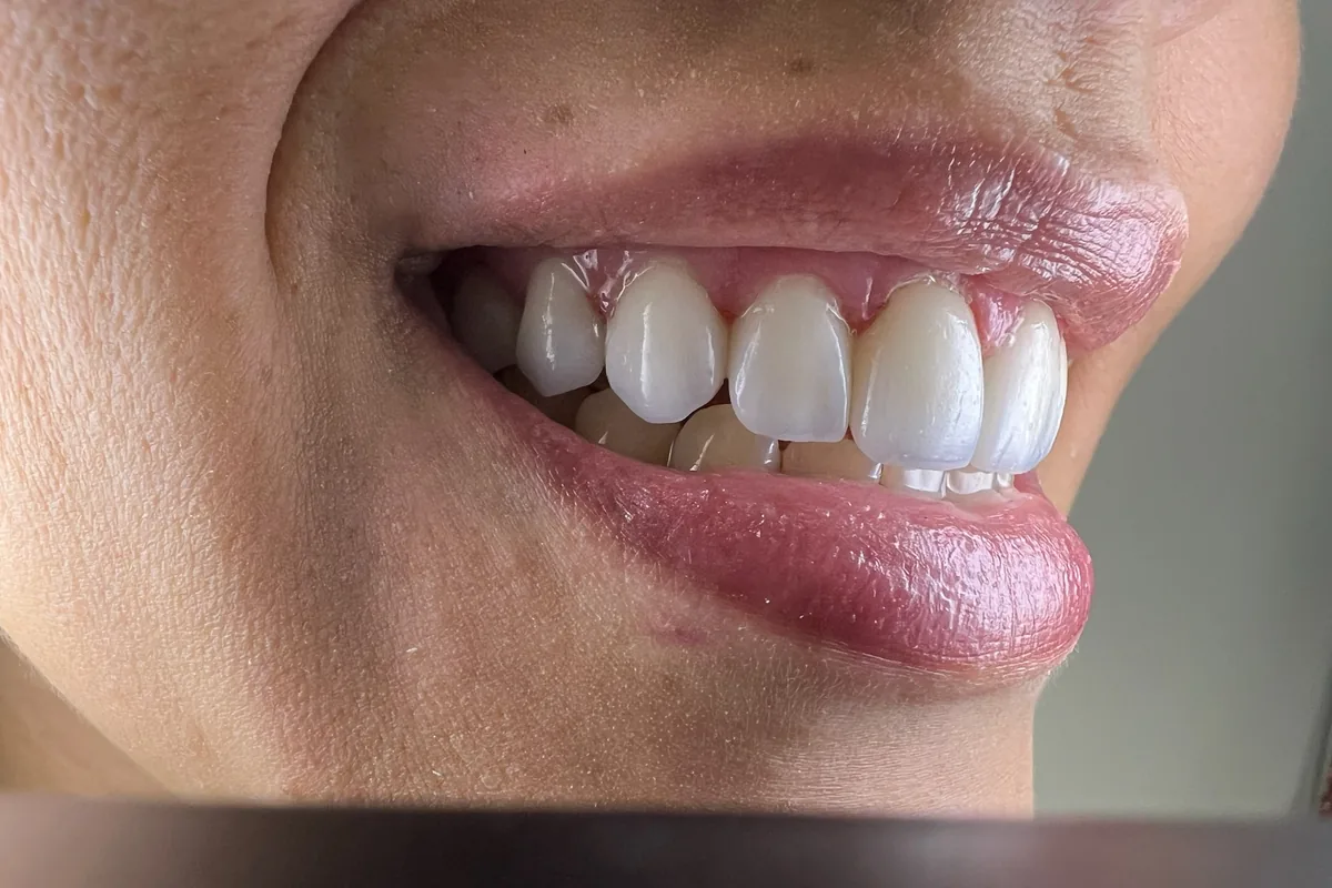 Close-up of a patient's smile, photographed at Art Dental Studio