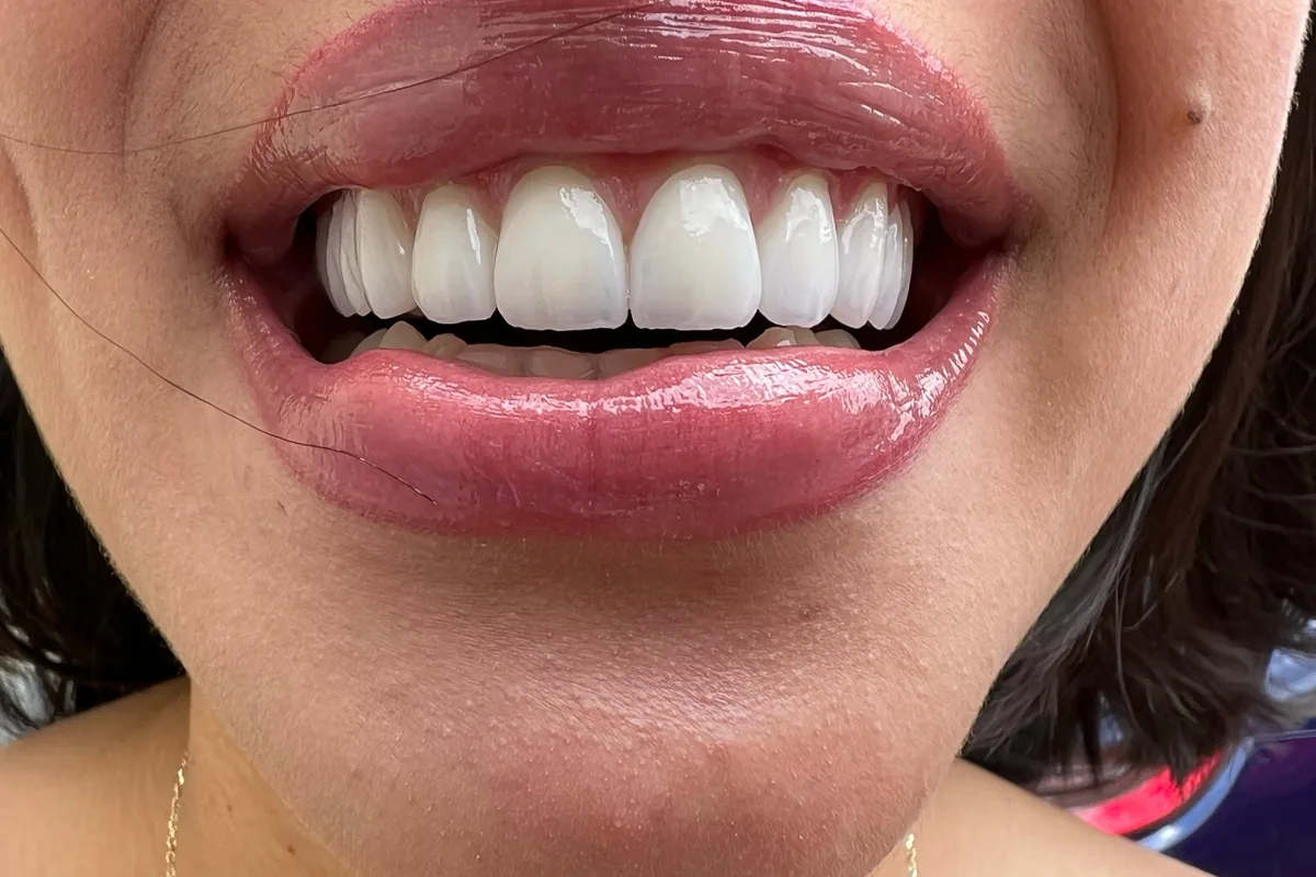 Close-up of a patient's smile, photographed at Art Dental Studio
