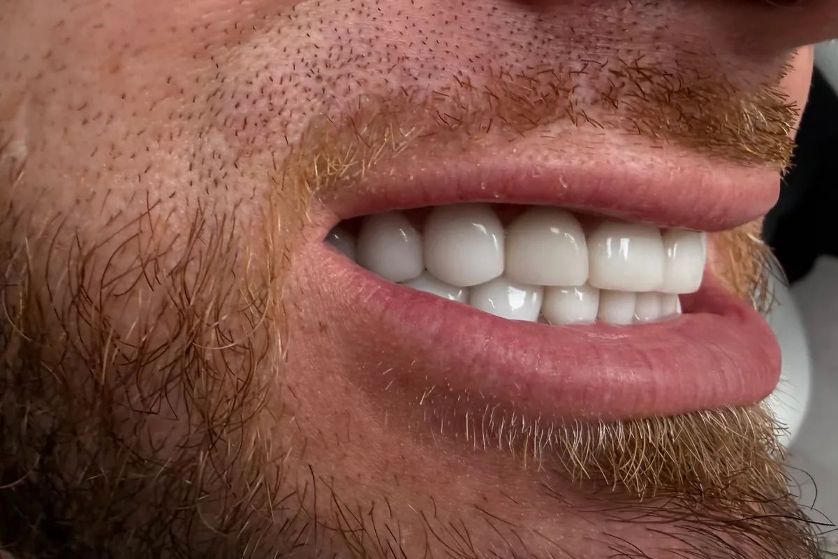 Primer plano de la sonrisa de un paciente, fotografiada en Art Dental Studio