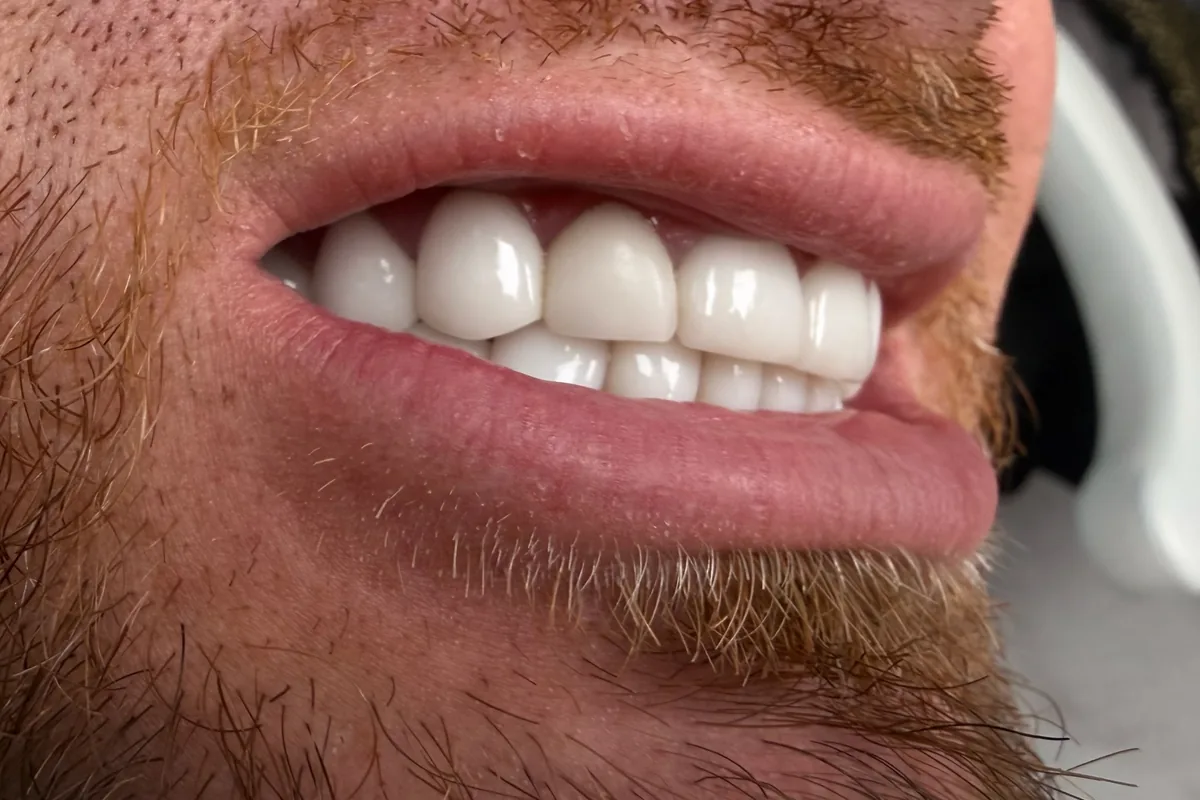 Primer plano de la sonrisa de un paciente, fotografiada en Art Dental Studio