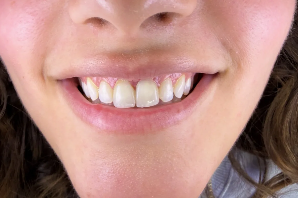 Primer plano de los dientes de un paciente, fotografiados en Art Dental Studio
