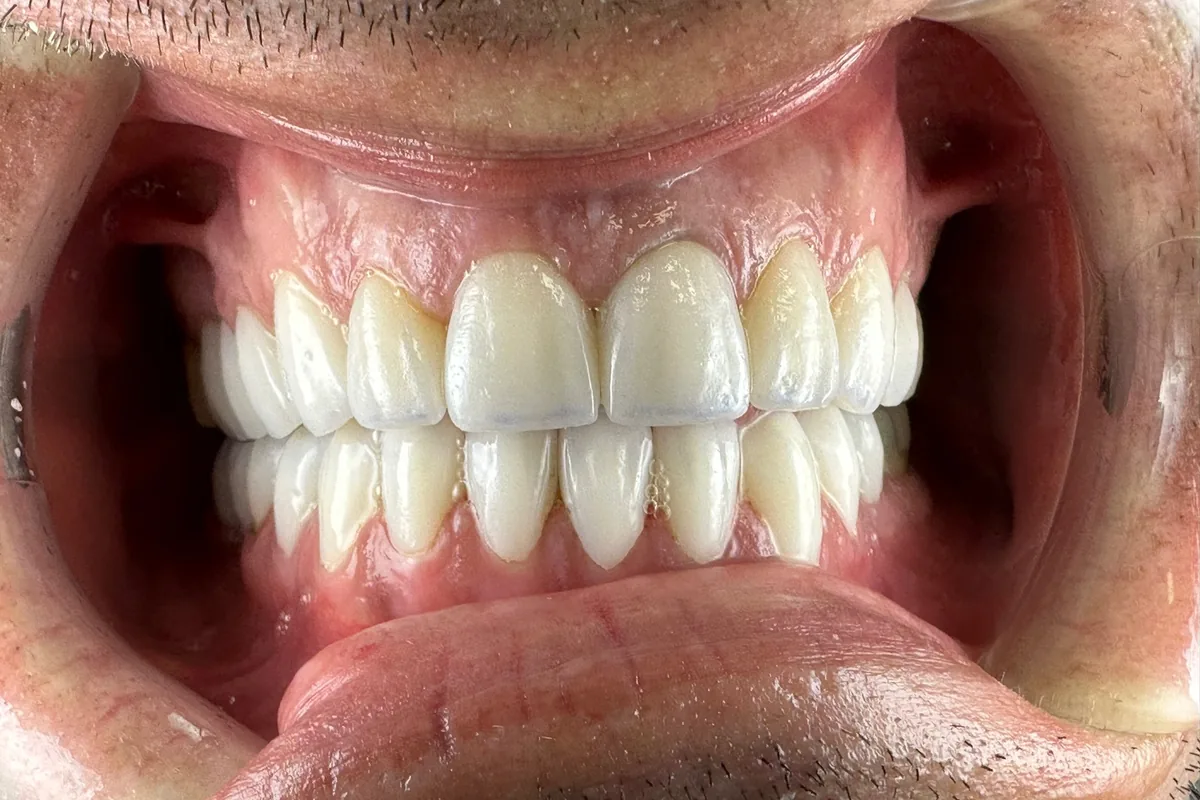 Primer plano de la sonrisa de un paciente, fotografiada en Art Dental Studio