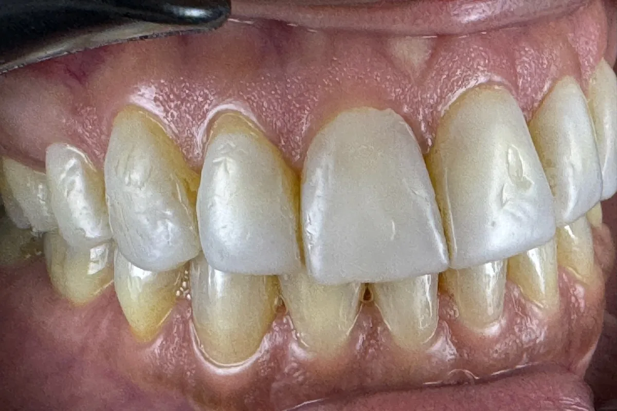 Close-up of a patient's smile, photographed at Art Dental Studio