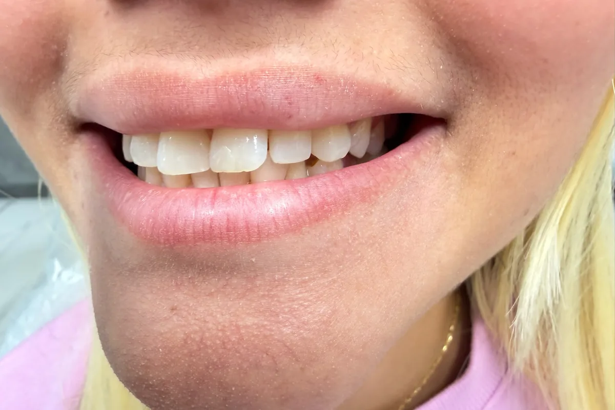 Close-up of a patient's smile, photographed at Art Dental Studio