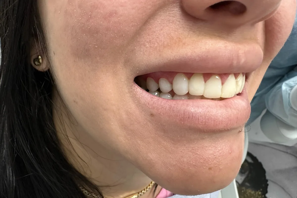 Close-up of a patient's smile, photographed at Art Dental Studio