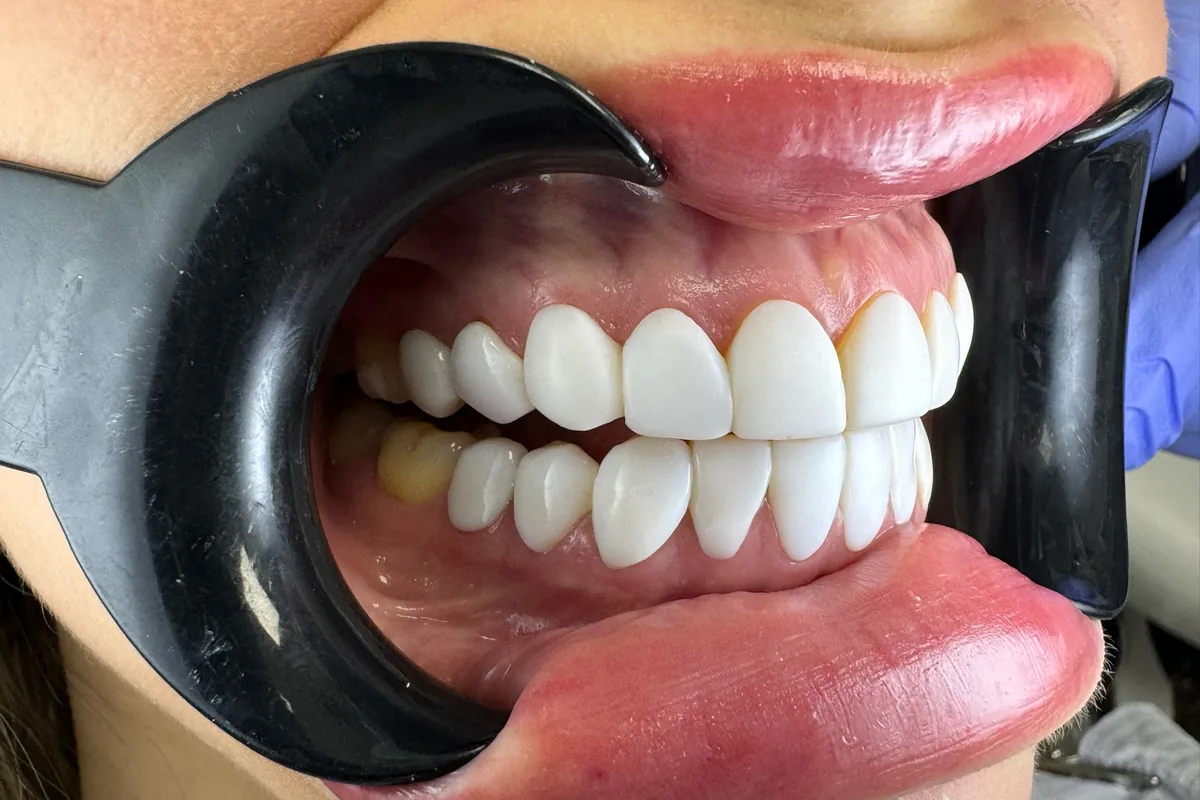 Close-up of a patient's smile, photographed at Art Dental Studio