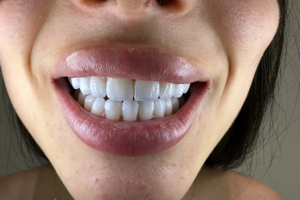 Close-up of a patient's smile, photographed at Art Dental Studio