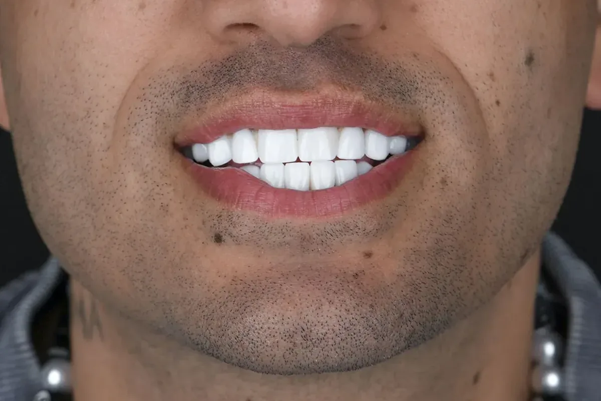 Primer plano de la sonrisa de un paciente, fotografiada en Art Dental Studio