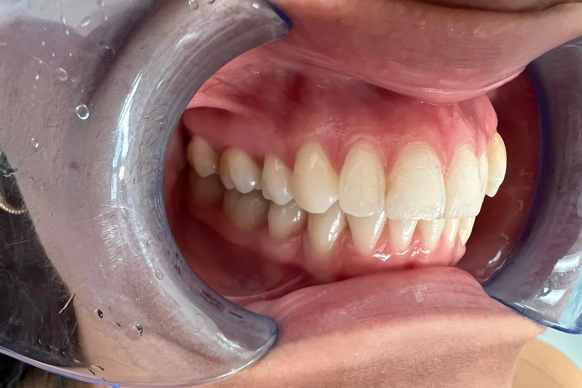 Primer plano de la sonrisa de un paciente, fotografiada en Art Dental Studio