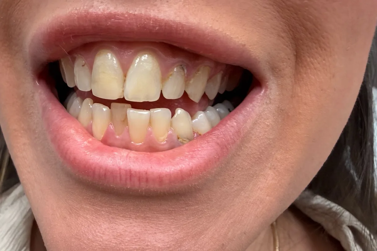Primer plano de los dientes de un paciente, fotografiados en Art Dental Studio