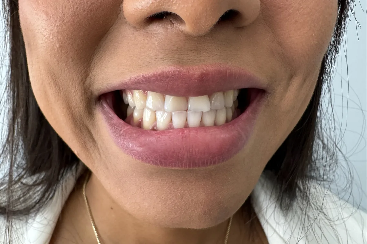 Primer plano de la sonrisa de un paciente, fotografiada en Art Dental Studio