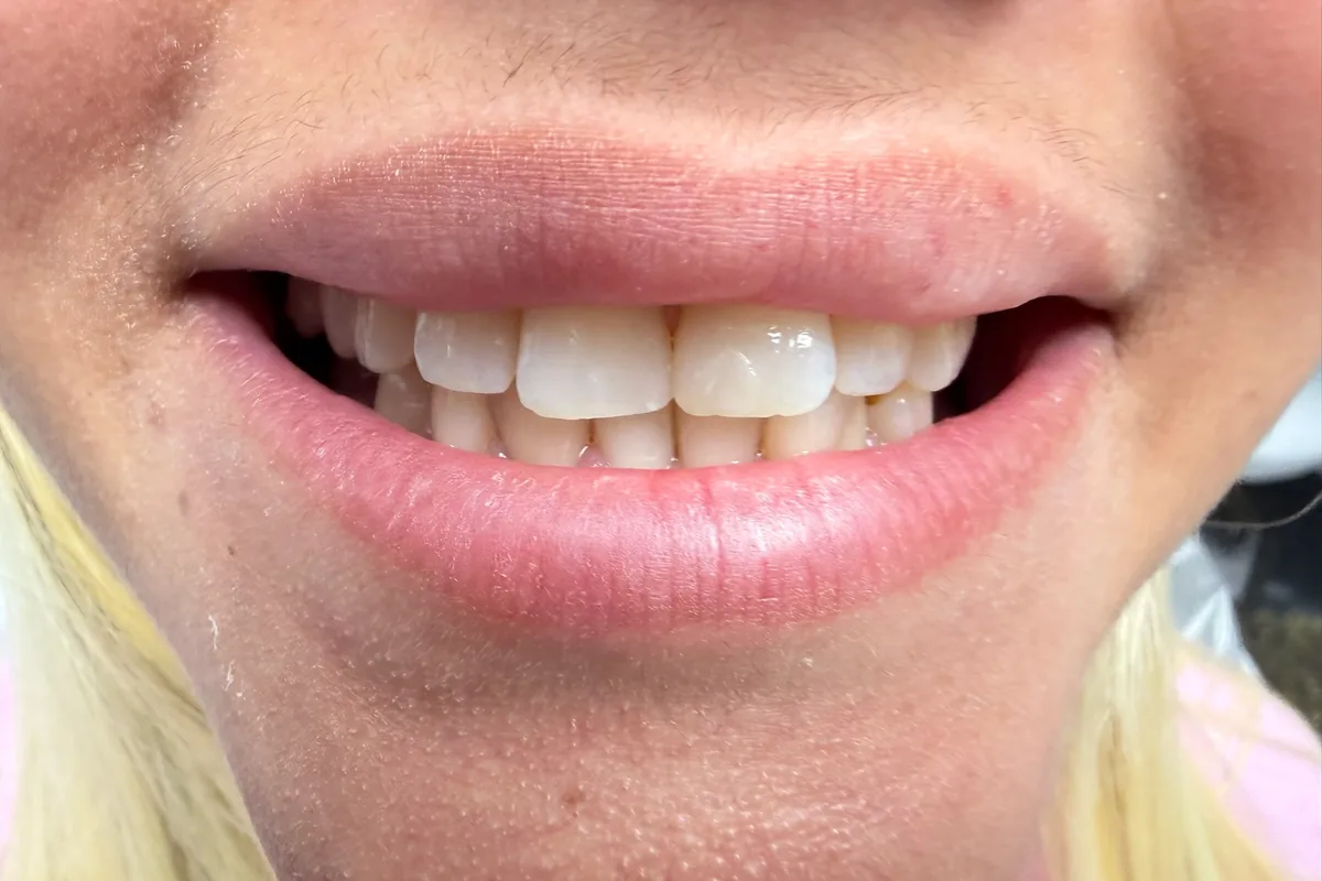 Close-up of a patient's smile, photographed at Art Dental Studio