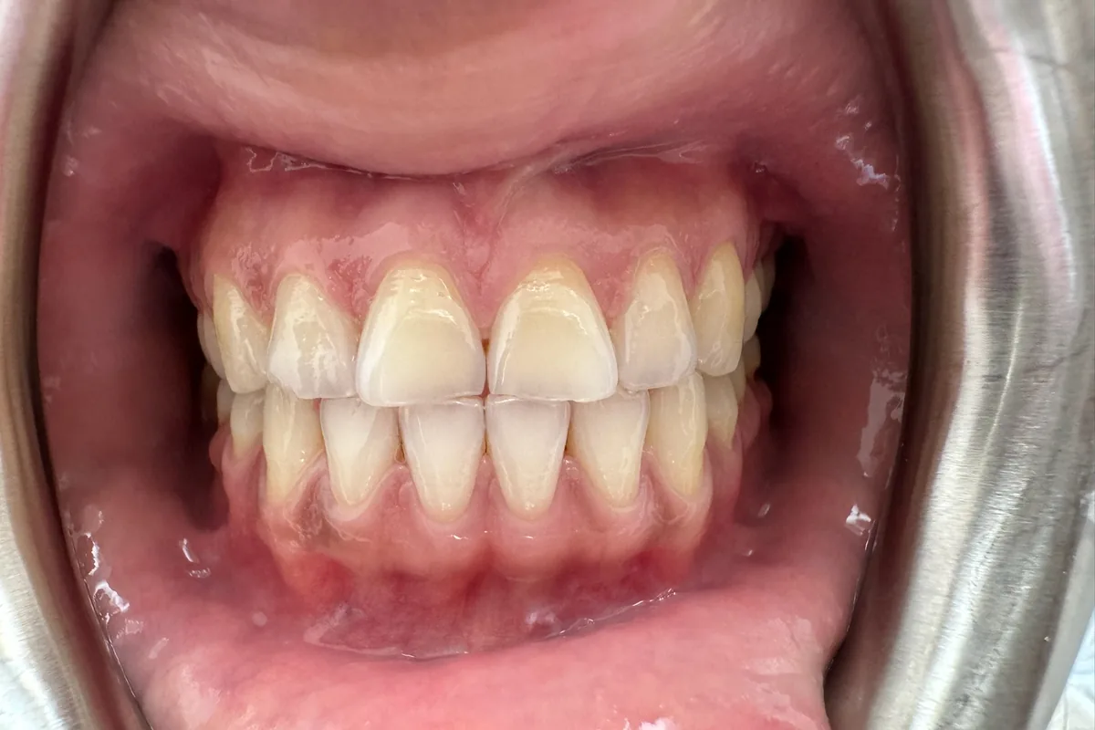 Close-up of a patient's smile, photographed at Art Dental Studio