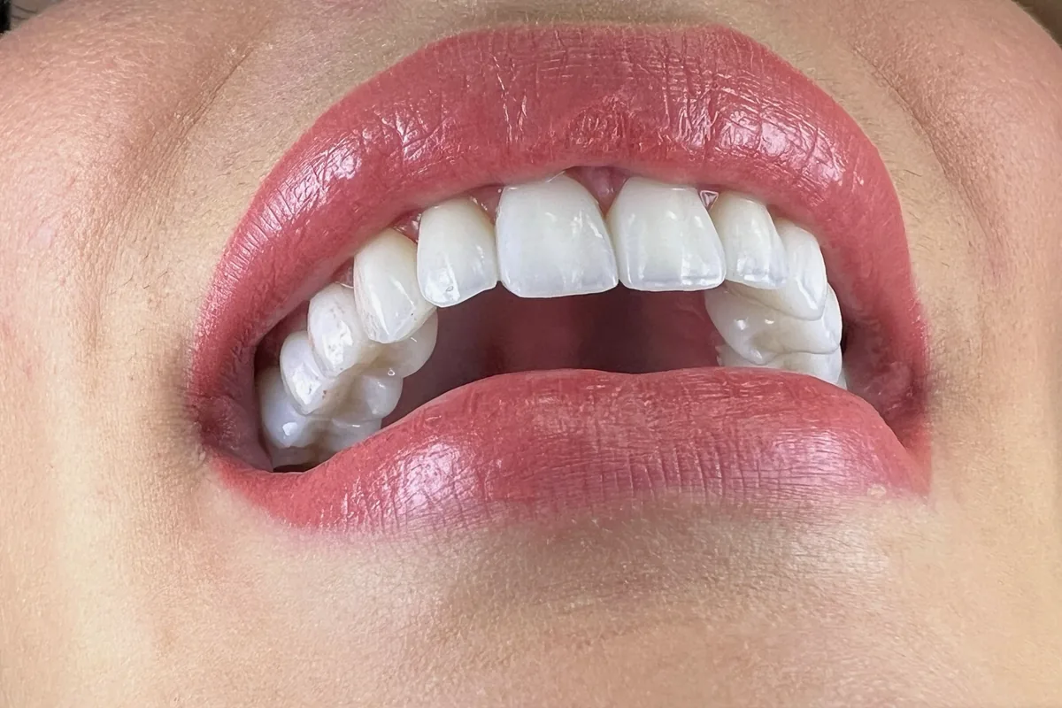 Close-up of a patient's smile, photographed at Art Dental Studio