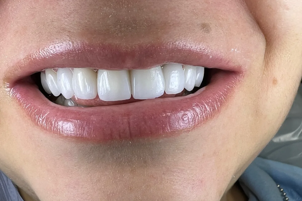 Close-up of a patient's smile, photographed at Art Dental Studio