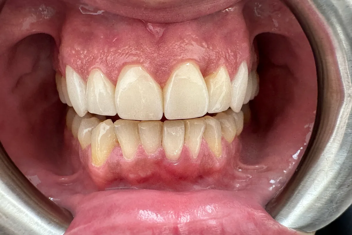 Close-up of a patient's smile, photographed at Art Dental Studio