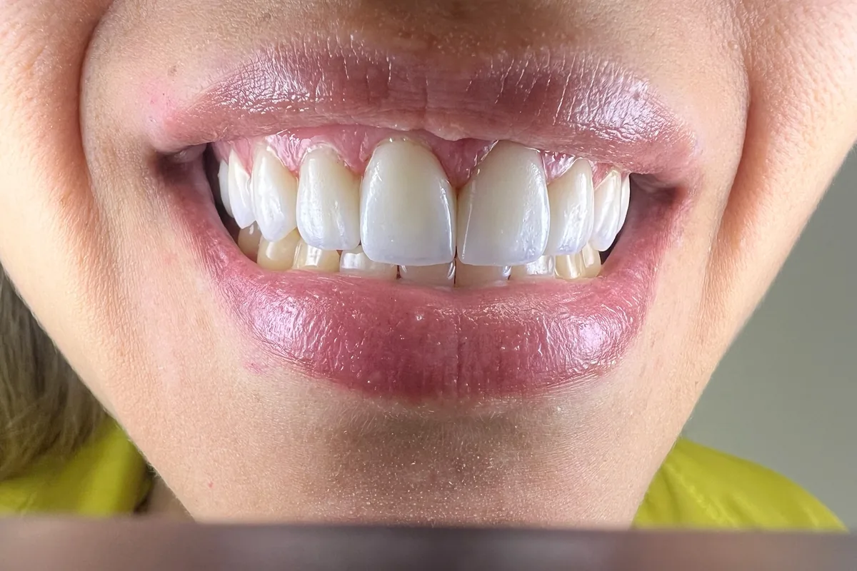 Primer plano de la sonrisa de un paciente, fotografiada en Art Dental Studio