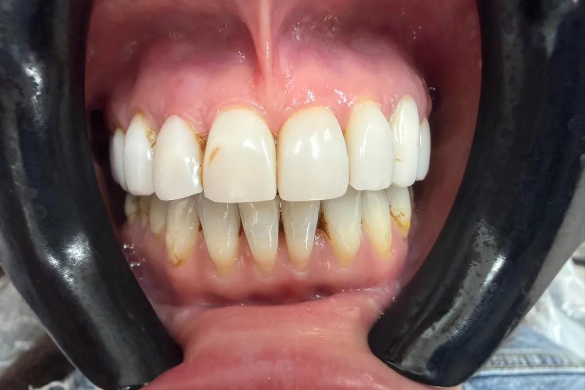 Close-up of a patient's smile, photographed at Art Dental Studio