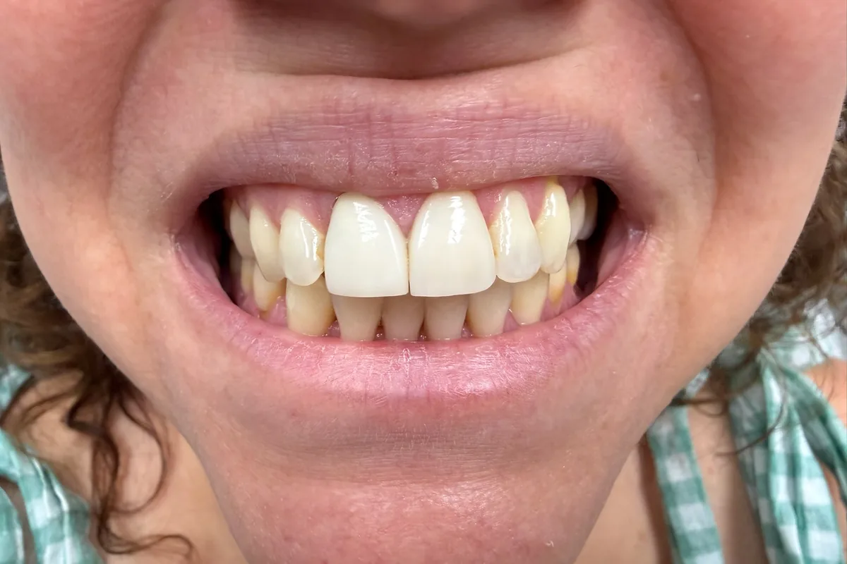 Close-up of a patient's smile, photographed at Art Dental Studio