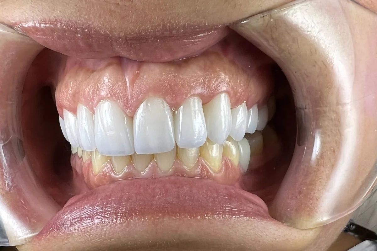 Primer plano de la sonrisa de un paciente, fotografiada en Art Dental Studio